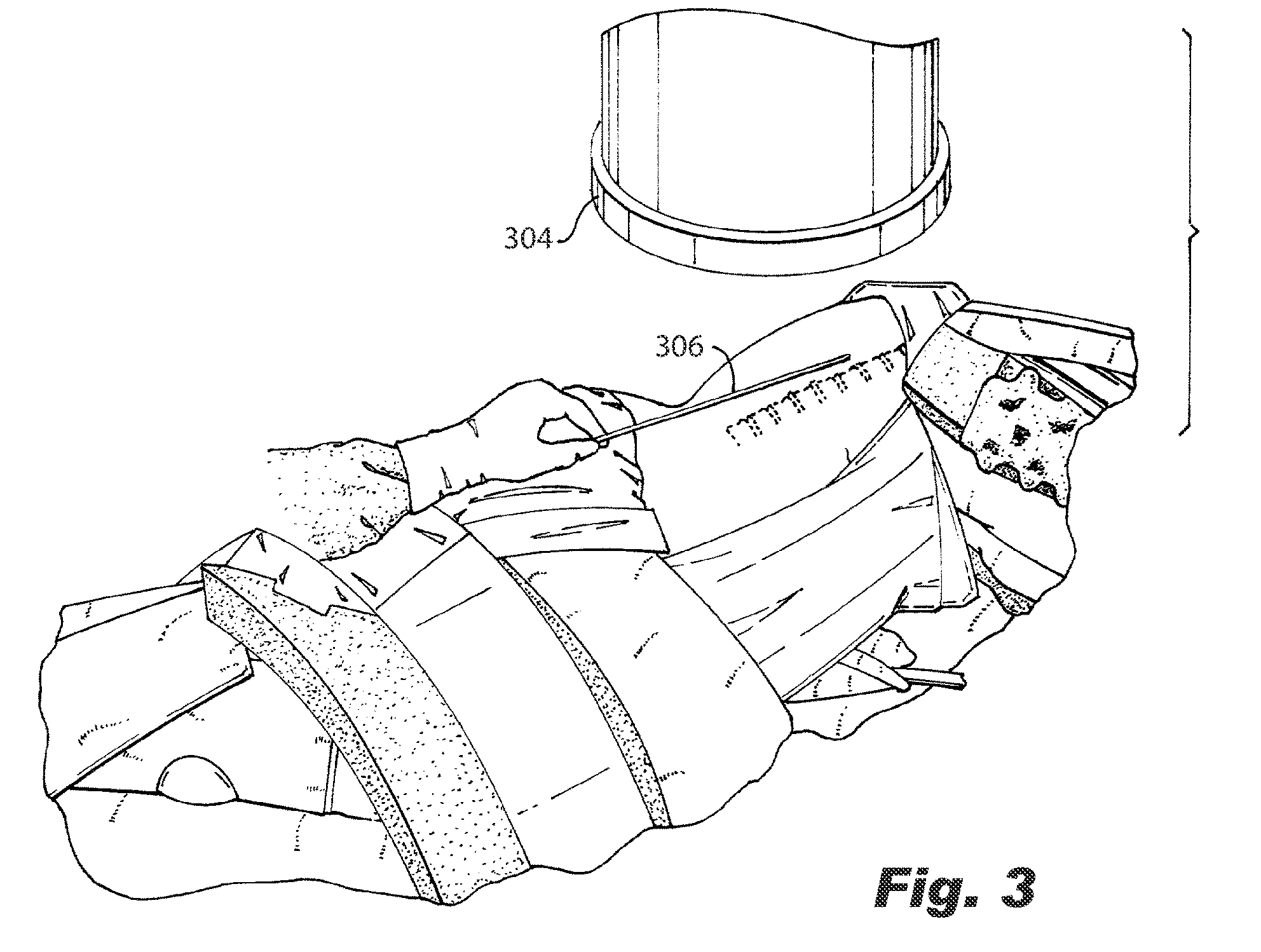 Advancements & Patents in ASC By Drs ABC 76 US-11389204-B2