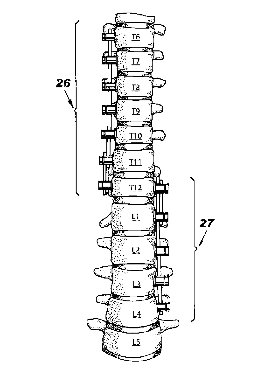 Advancements & Patents in ASC By Drs ABC 80 US-11602376-B2