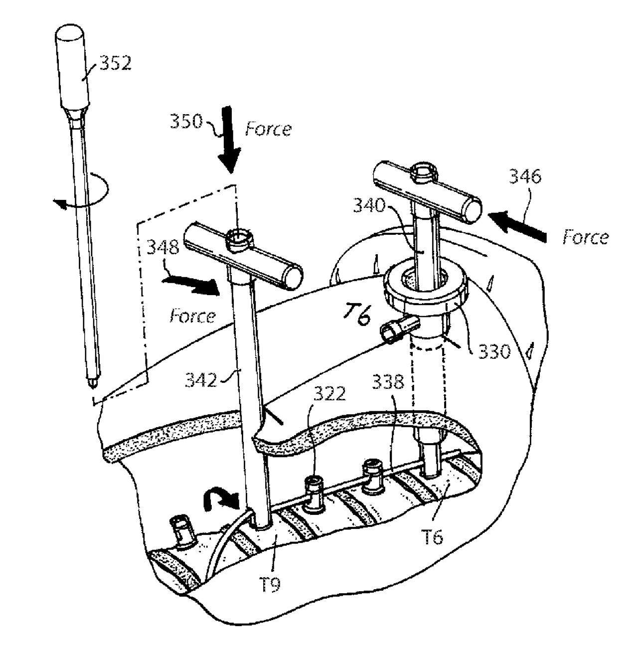 Advancements & Patents in ASC By Drs ABC 82 US-11737788-B2 Illustration