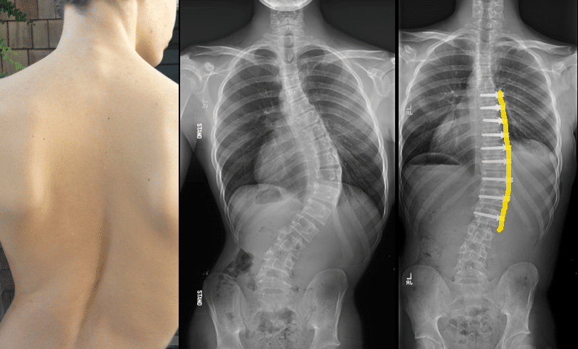 ASC (Anterior Scoliosis Correction) Before and After photo ASC (Anterior Scoliosis Correction)