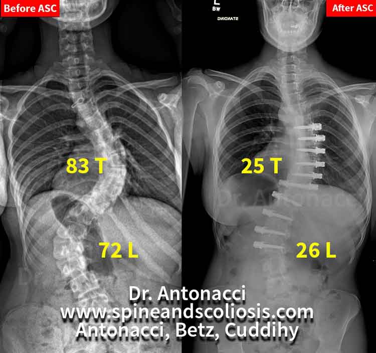 Before After Scoliosis Surgery - Double Curve