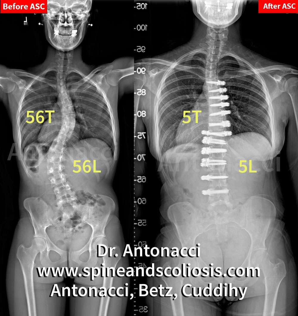SP 21y/o Before After ASC Scoliosis Surgery - Double Curve
